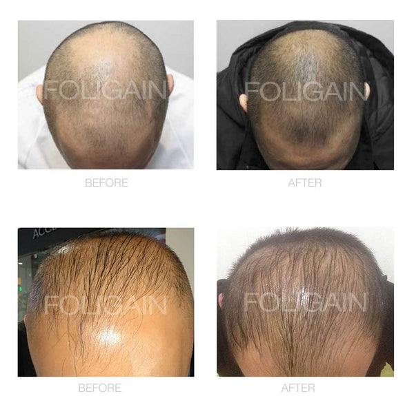 FOLIGAIN® Mens's Hair Regrowth Kit - FOLIGAIN EUROPE