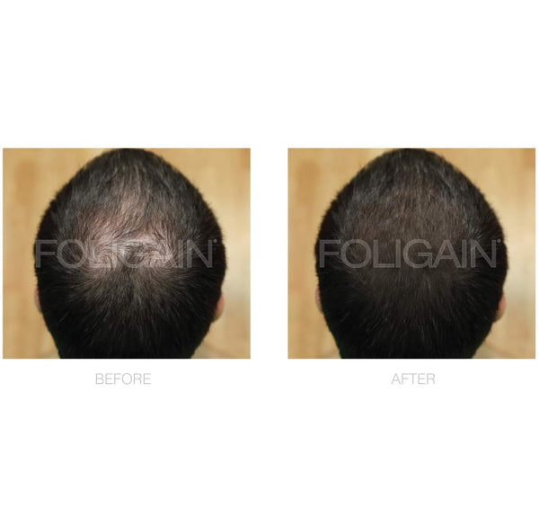 FOLIGAIN Advanced Hair Regrowth For Men Minoxidil 5% + Trioxidil 5% - FOLIGAIN EU