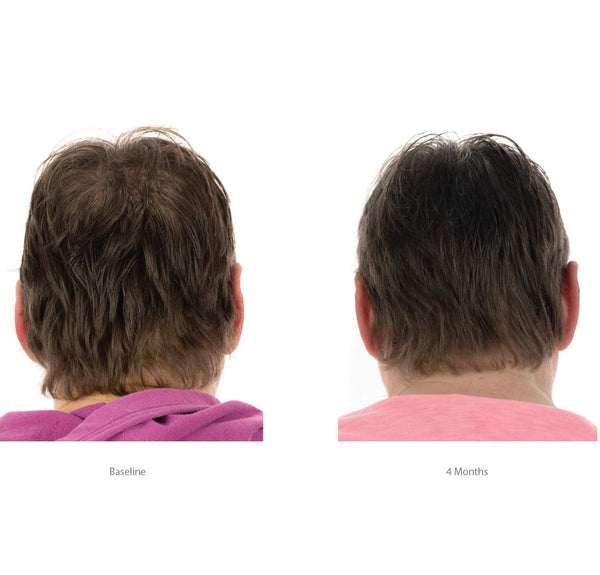 FOLIGAIN Triple Action Shampoo For Thinning Hair For Women with 2% Trioxidil