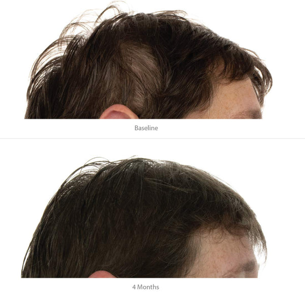 FOLIGAIN Women's Hair Regrowth Kit - FOLIGAIN EUROPE